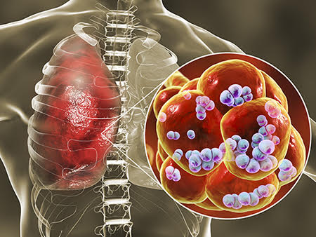 COSA SONO LE POLMONITI? CONOSCIAMO MEGLIO LA POLMONITE PNEUMOCOCCICA